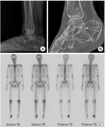 Fig. 2. Bone biopsy result performed on right lateral calcaneal wall  on May 2012. (A) Intense activation of osteoclast (arrows) showing  bone resorption
