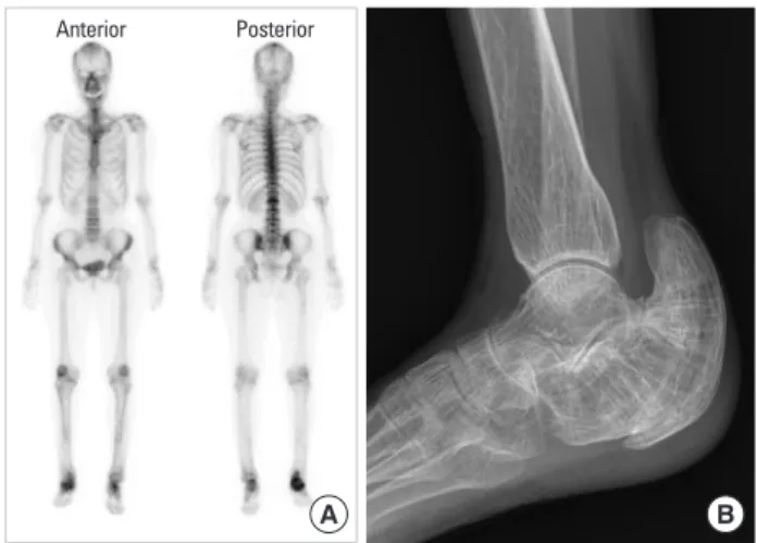 Fig. 6. Follow-up radiologic evaluation in 2019, whole body bone scan  (A) and lateral plain X-ray of right ankle presenting bony deformity (B).