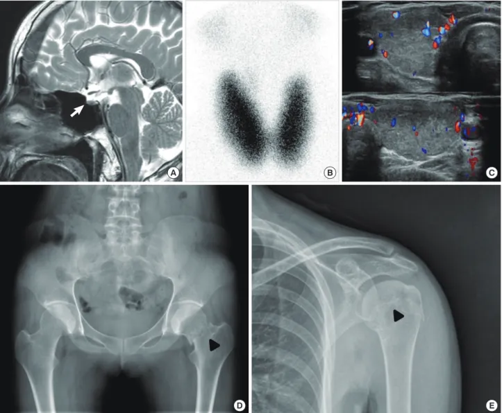 Fig. 1. Image findings of the patient. (A) Mid-sagittal T2-weighted image showing thinning of the lower half of the pituitary stalk (arrow)