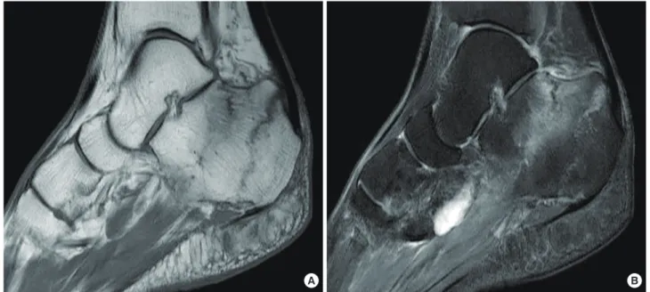 Fig. 3. Sagittal T1-weighted image demonstrating two parallel lines with a low signal intensity (A), and T2-weighted image showing high signal  intensity in the corresponding lesions (B).