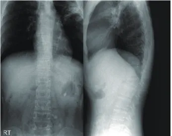 Fig. 1. Compression fracture of the L1 body and mild diffuse osteoar- osteoar-thritic change in facet joints.
