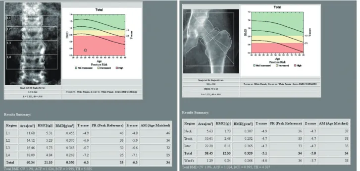 Fig. 2. Bone mineral density (BMD) showed markedly reduced bone density in lumbar spine and femur.