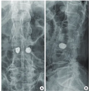 Fig. 3. Coronal image (A) and saggital image (B) of lumbar spine 3-di- 3-di-mensional computed tomography scan and T1-weighted saggital  im-age (C) of lumbosacral magnetic resonance imaging shows ankylosed  of ligaments, intervertebral discs, endplate, and