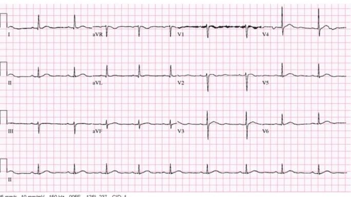 Fig. 2. Electrocardiogram (ECG) finding on admission. 
