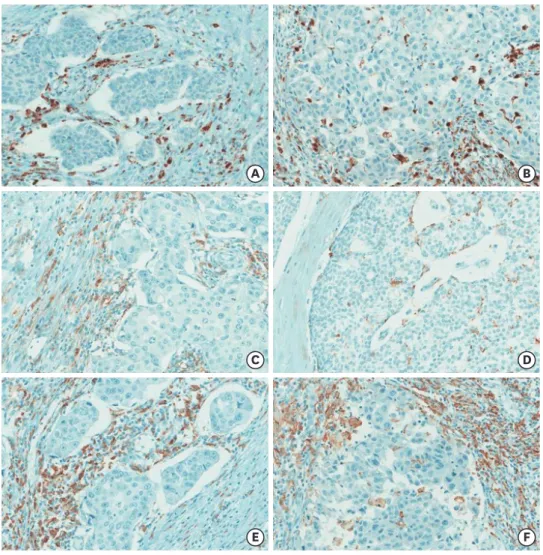 Figure 1. Representative images of IHC analysis of TAM markers in IBC. (A) CD68+ macrophages are mostly  present in TS (IHC for CD68, 400× magnification)