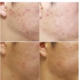 Figure 3. Change of left cheek Figure 5. Change of right cheek