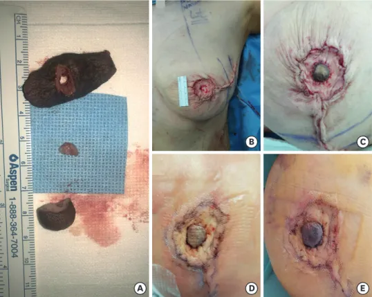Figure 1. The procedure of immediate nipple grafting and the progression of graft survival (A) After completion  of skin-sparing mastectomy, the nipple-areolar complex was separated from the specimen, and the nipple was  severed