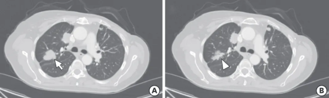 Figure 3. Chest computed tomography (CT) scan before (August 2018) and after (April 2019) the azacitidine (AZA)  treatment