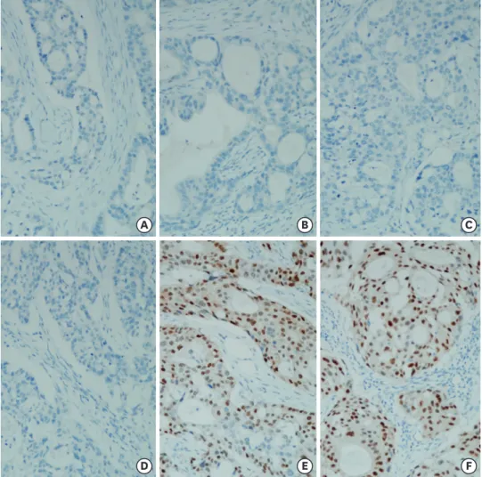 Figure 3. Pathological images of samples from the parotid cancer that metastasized to the breast and the primary  parotid cancer