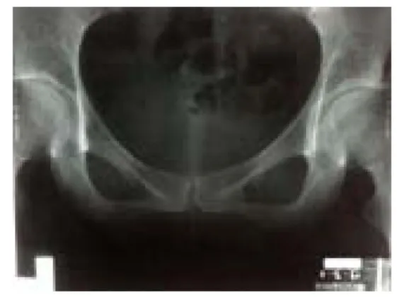 Fig.  1.  X-ray  :  coccyx  Lat.(09.02.02)
