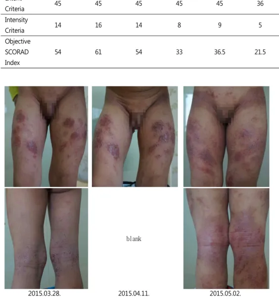 Table  3.  Clinical  Progress  of  Objective  SCORAD  Index