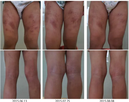 Fig.  2.  Pictures  of  Atopic  Dermatitis  lesions
