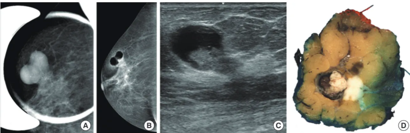 Figure 2. Histological characteristics and immunoprofile. (A) An intracystic papillary component (right) is surrounded by a thick fibrous capsule and an  invasive carcinoma (left) component on the low-power view of the lesion (H&amp;E stain, ×1.2)