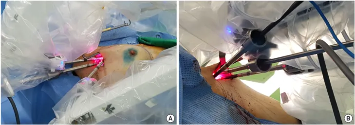 Figure 3. Docking status. (A) Fenestrated bipolar forceps and permanent cautery spatula were placed on both lateral sides of the scope