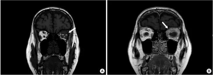 Figure 2. Histopathologic examination of the left orbital biopsy. (A) Connective tissue with diffuse and cordonal infiltrate of round and plasmacytoid  neoplastic cells (H&amp;E stain, ×200)