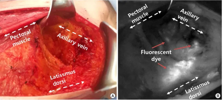 Figure 1. Axillary lymph node dissection with lymphatic mapping on indocyanine green. (A) Axillary lymph node dissection seen in surgical field