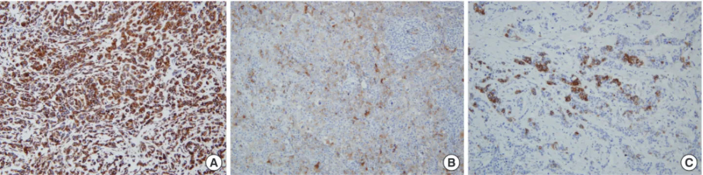 Figure 1. Representative examples of immunohistochemical staining (IHC) for epithelial-mesenchymal transition marker in breast cancers