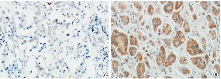 Figure 1. Representative photographs of Wnt7a expression in the cytoplasm of neoplastic cells
