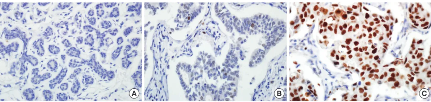 Figure 1. Immunohistochemical analysis of enhancer of zeste homologue 2 (EZH2) expression in invasive ductal carcinoma of breast (×400): (A) nor- nor-mal breast tissue, (B) low, and (C) high expression