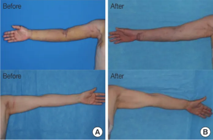 Figure 2. Lymphoscintigraphy evaluation. (A) Preoperative evaluation  which seen in dermal back flow of right forearm