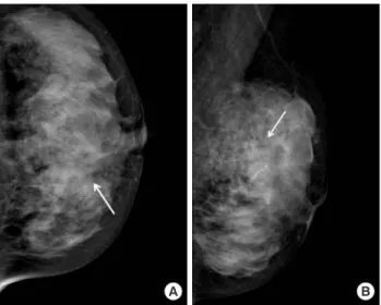 Figure 1. Initial mammograms. The cranio-caudal  (A) and medio-later- medio-later-aloblique (B) mammogram show fine pleomorphic microcalcifications in  the left upper inner breast (arrows)
