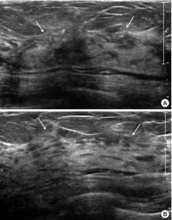 Figure 7. Histopathologic features of the core biopsy specimen of the left breast mass
