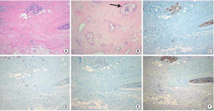 Figure 8. Histopathologic features of the surgical specimen of the left mastectomy after neoadjuvant chemotherapy