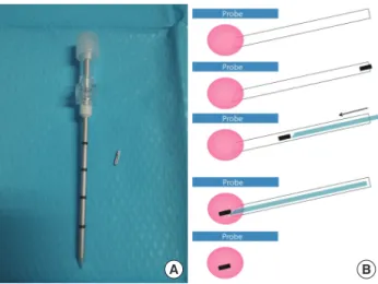 Figure 1. Schematic diagram of the preoperative ultrasonography (US)- (US)-guided surgical clip insertion
