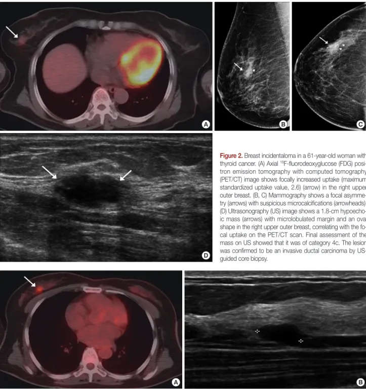 Figure 3. Breast incidentaloma in a 48-year-old woman with lymphoma. (A) Axial  18 F-fluorodeoxyglucose (FDG) positron emission tomography with  computed tomography (PET/CT) image shows focally increased uptake (maximum standardized uptake value, 5.7) (arr