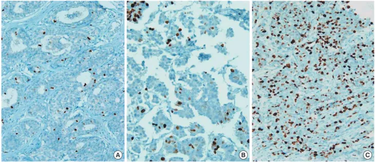 Figure 1. Immunohistochemical stains for Ki-67 in the breast cancers. Low labeling index (<10%) (A), intermediate (10%–20%) (B), and high labeling  index (>20%) (C) based on Eye-10 method (×100).
