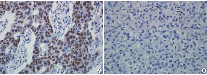 Figure 1. Immunohistochemical analyses of AT-rich interactive domain 1A (ARID1A) expression in breast cancer: (A) high and (B) low expression