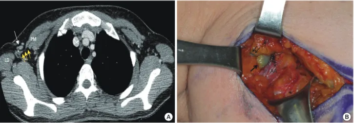 Figure 1. The relationship between axillary arch and the location of sentinel lymph nodes (SLNs)