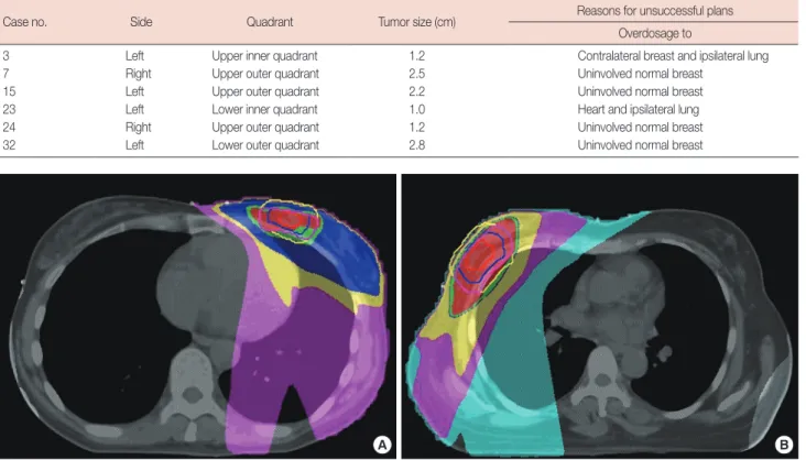 Figure 2. Dose distribution of two patients off-protocol. (A) Case 23 with tumor located in low inner quadrant, dose of heart and ipsilateral lung is in  excess of the evaluation criteria of RTOG-0319