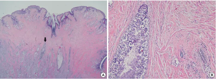 Figure 1. Microscopic findings of nipple involvement. (A) The sagittal section of nipple shows involvement of tumor (black arrow) without epidermal in- in-volvement (H&amp;E stain, ×2.5)