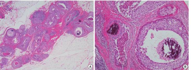 Figure 2. Histopathologic findings of ectopic breast carcinoma. (A) Ductal epithelial proliferative lesion with multiple foci of necrosis and microcalcifica- microcalcifica-tion is noted (H&amp;E stain, ×20)