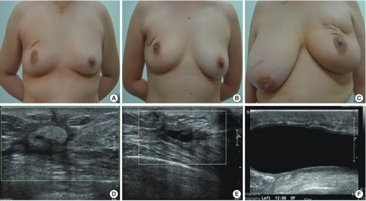 Figure 1. Cosmetic outcomes and sonographic findings. (A, D) Good cosmetic outcome. Sonography indicated echogenic materials (in a 51-year-old  woman with infiltrating ductal carcinoma [IDC] at 20 months after operation)