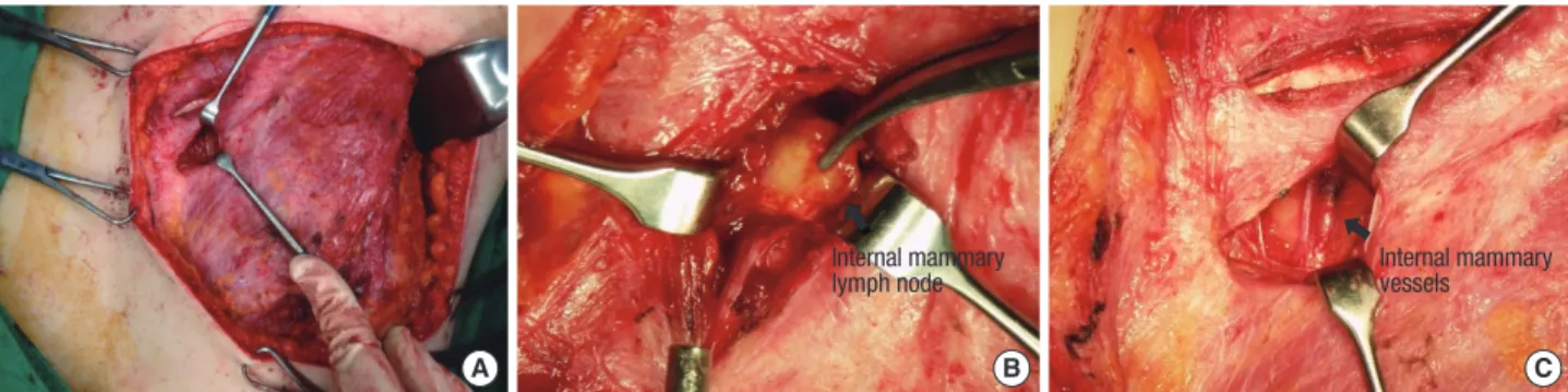 Figure 1. Operation field showed internal mammary lymph node (IMLN) biopsy after modified radical mastectomy