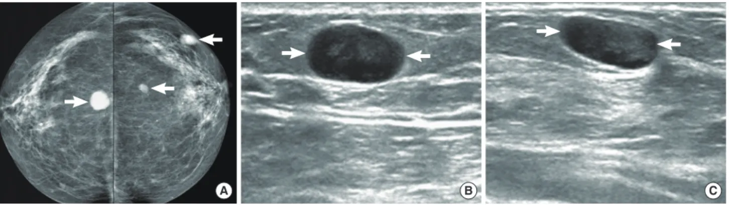Figure 1. A 61-year-old woman with diffuse large B-cell lymphoma. (A) Both craniocaudal mammograms show multiple circumscribed oval or round  masses (arrows) in both breasts