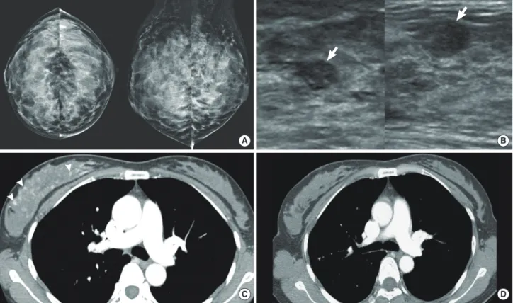 Figure 3. A 46-year-old woman with diffuse large B-cell lymphoma. (A) Both craniocaudal and mediolateral oblique mammograms are negative