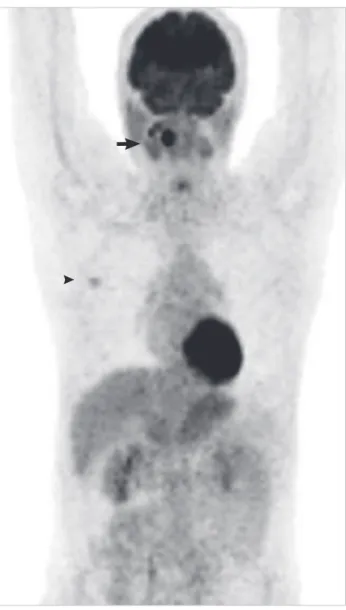Figure 2. Positron emission tomography (PET) maximal intensity projec- projec-tion image showing the whole body PET image wherein both the base  of tongue lesion (arrow) and the right breast lesion (arrowhead) are seen.