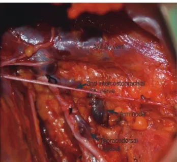 Figure 1. Arm node. The arm node is usually located between the lower  level of axillary vein and above or at the level of the second  intercosto-brachial nerve.