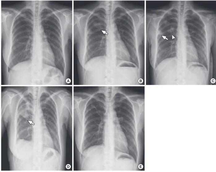 Figure 1. (A) Chest PA at symptom presentation (10 days before emergency room visit). No remarkable findings are observed
