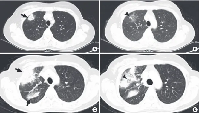Figure 3. Microscopic appearance of the lung wedge resection specimen. 