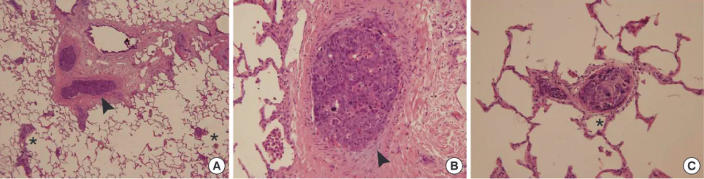Figure 4. (A) Arrowhead and asterisk indicate intravascular and endolymphatic tumor emboli, respectively