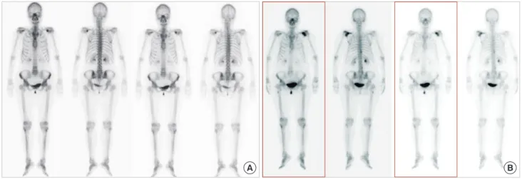 Figure 2. A mild, focal hot uptake is newly developed in right femur shaft. Figure 3. X-ray shows no skeletal abnormalities.