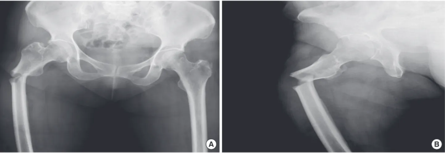 Figure 5. Postoperative state of the fracture site. Figure 6. X-ray shows cortical beaking of the left femur (circle).