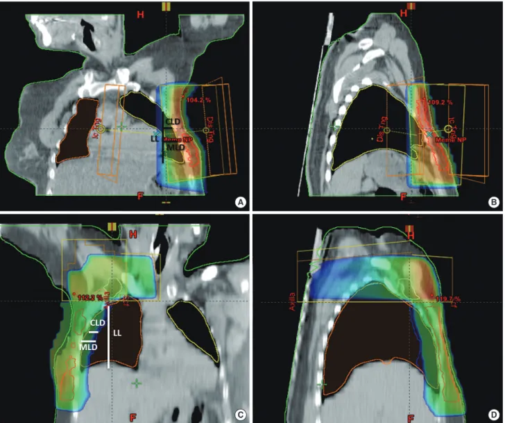Figure 1. Dose distribution in patients included in this study. The lung and target doses are demonstrated on (A) coronal and (B) sagittal sections with  2-field radiotherapy