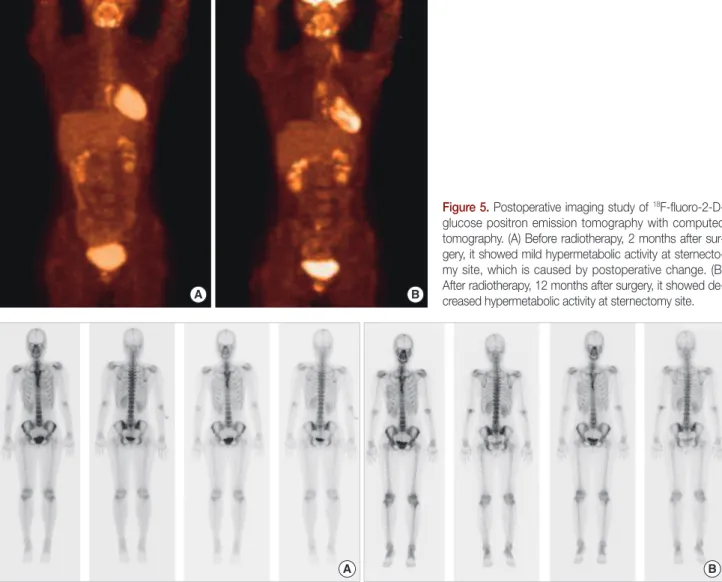 Figure 5. Postoperative imaging study of  18 F-fluoro-2-D- F-fluoro-2-D-glucose positron emission tomography with computed  tomography