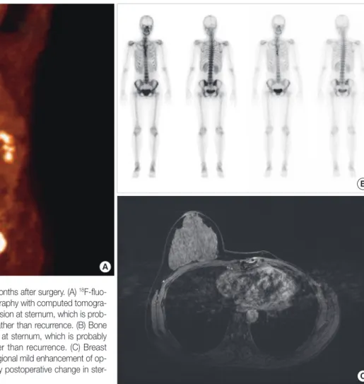 Figure 7. Recent breast imagings, 36 months after surgery. (A)  18 F-fluo- F-fluo-ro-2-D-glucose positron emission tomography with computed  tomogra-phy showed mild focal hypermetabolic lesion at sternum, which is  prob-ably postoperative change in sternum