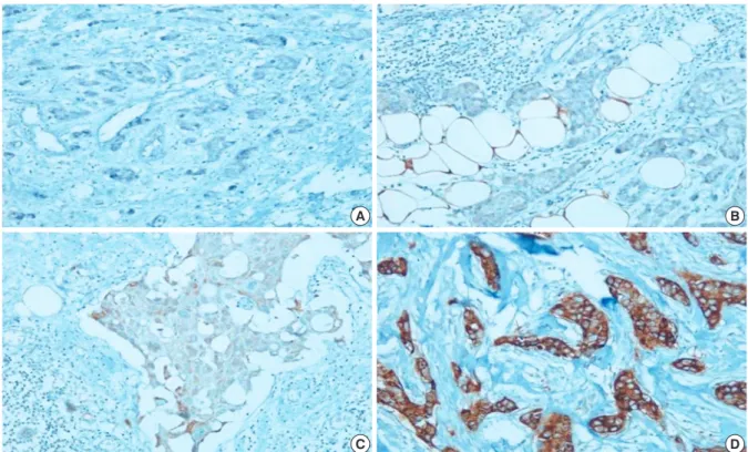 Figure 1. αB-crystallin expression scoring. Staining was graded as follows: 0, negative staining; 1, weakly positive staining; 2, moderately positive  staining; 3, highly positive staining (Immunohistochemical staining for αB-crystallin, ×100).